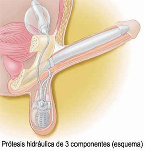 2_protesis-pene-hidrahulica