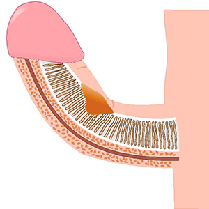 6_tratamiento-pene-torcido-peyronie