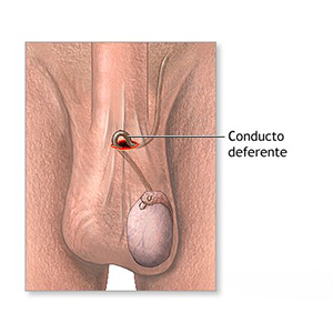 9_vasectomia2